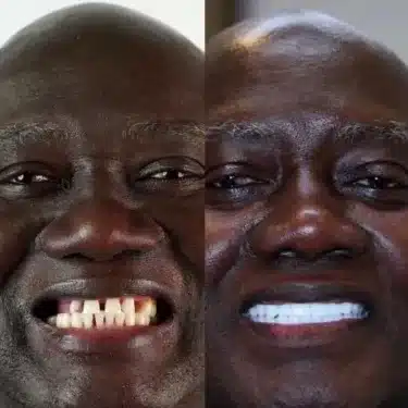 Implants dentaires