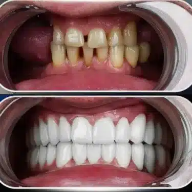 Implantes dentales