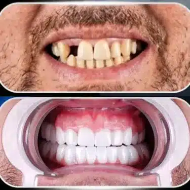 Implantes dentales