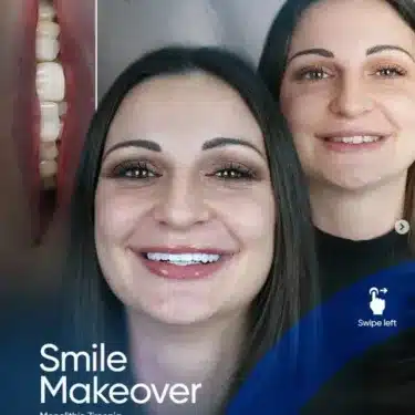 Hollywood Smile