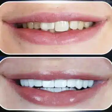 Hollywood Smile