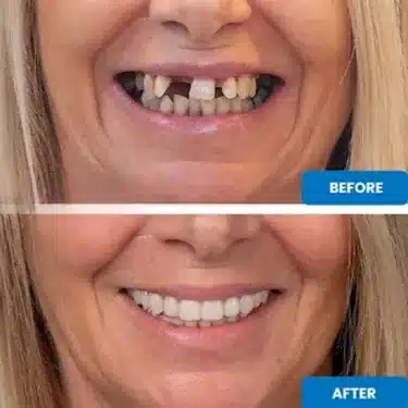 Implantes dentales