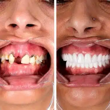 Implantes dentales