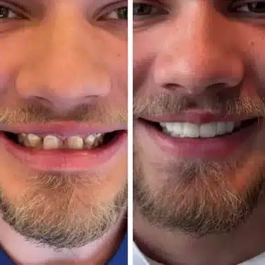 Implantes dentales