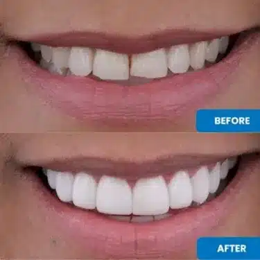 Carillas (Sonrisa de Hollywood)
