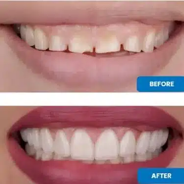 Carillas (Sonrisa de Hollywood)