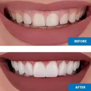 Carillas (Sonrisa de Hollywood)