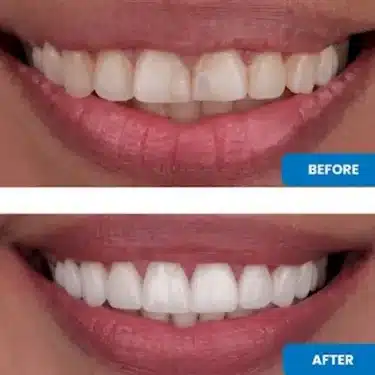 Carillas (Sonrisa de Hollywood)