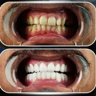 Hollywood Smile