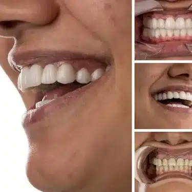 Implants dentaires
