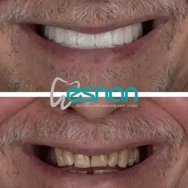 Implants dentaires