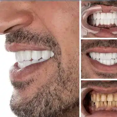 Implants dentaires