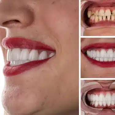 Implants dentaires