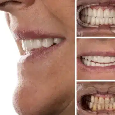 Implants dentaires