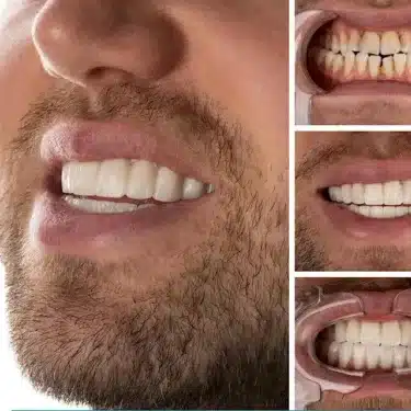Smile Design