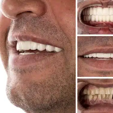 Smile Design