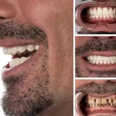 Smile Design