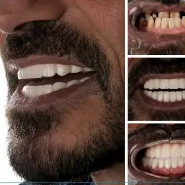 Smile Design