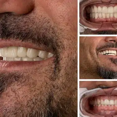 Smile Design