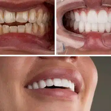Smile Design