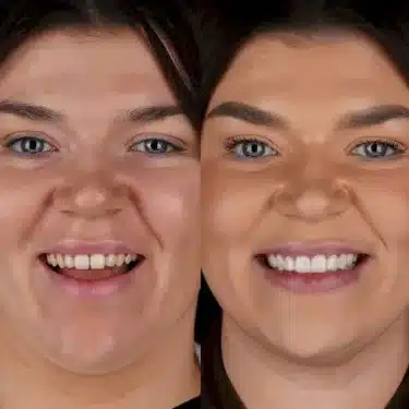 Facettes