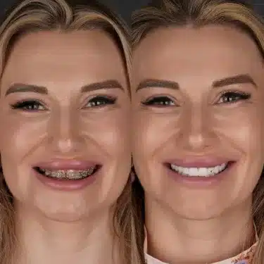Facettes