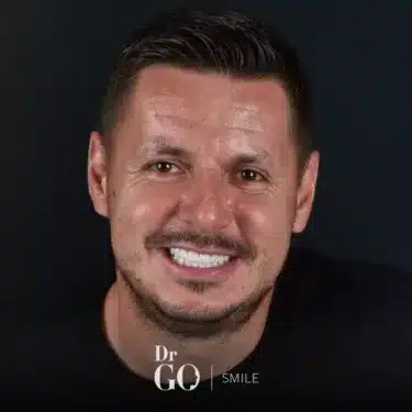Sonrisa de Hollywood
