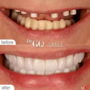 Implantación All-on-6