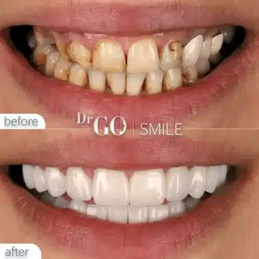 Implantación dental