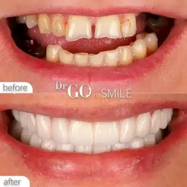 Implantación dental