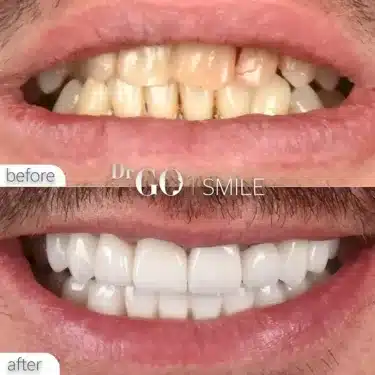 Implantación dental