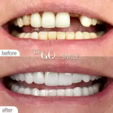 Implantación dental