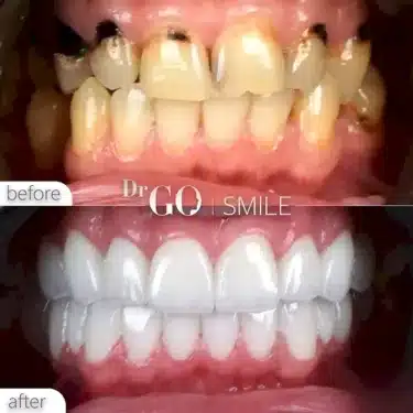 Implantación dental
