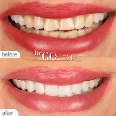 Blanqueamiento dental