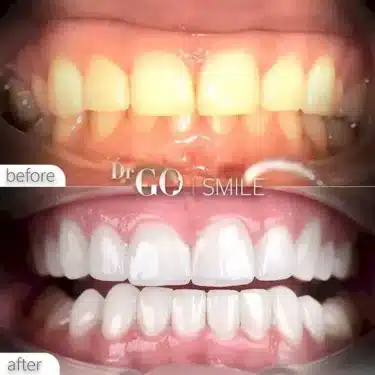Blanqueamiento dental