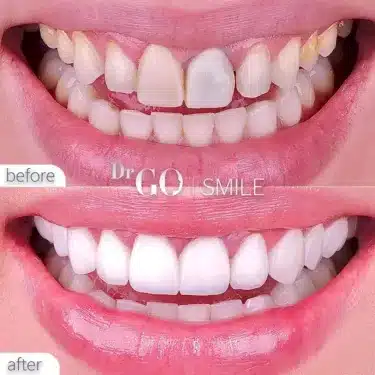 Blanqueamiento dental
