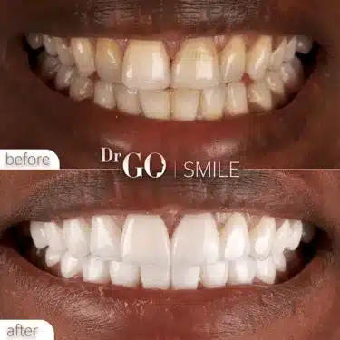 Blanqueamiento dental