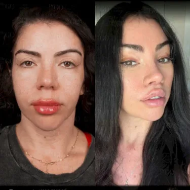 Facelift