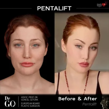 Facelift