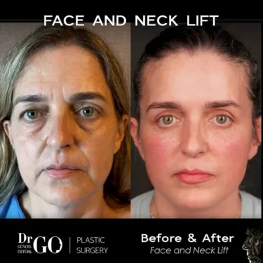 Facelift