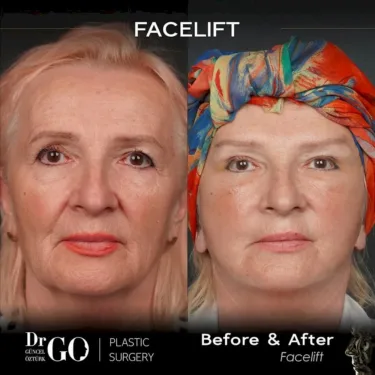 Facelift