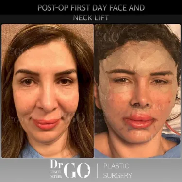 Facelift