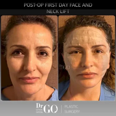 Facelift