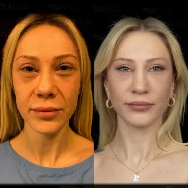 Facelift