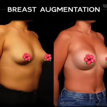Mammoplasty