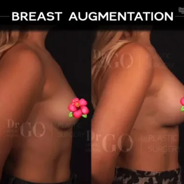 Mammoplasty