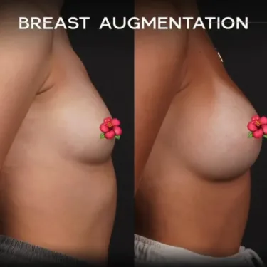 Mammoplasty