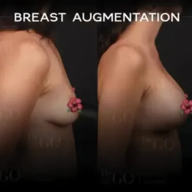 Mammoplasty
