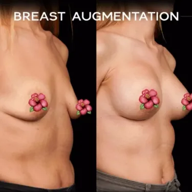 Mammoplasty