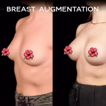 Mammoplasty